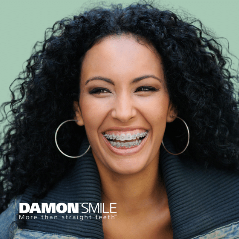 Damon Self-Ligating Braces Katy Park Orthodontics in Katy, TX